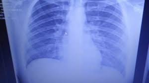 ΣΗΜΕΡΑ: Ημερίδα ενημέρωσης για τον καρκίνο του πνεύμονα στη Μηχανιώνα