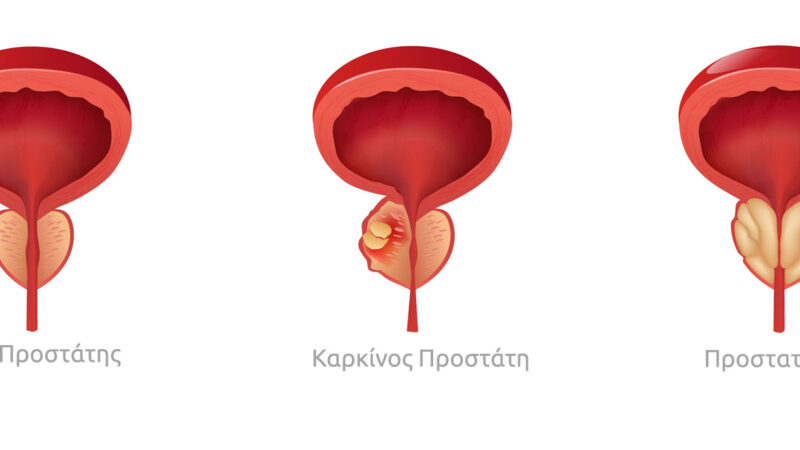 Τι πρέπει να ξέρουμε για την οξεία και χρόνια προστατίτιδα (BINTEO)