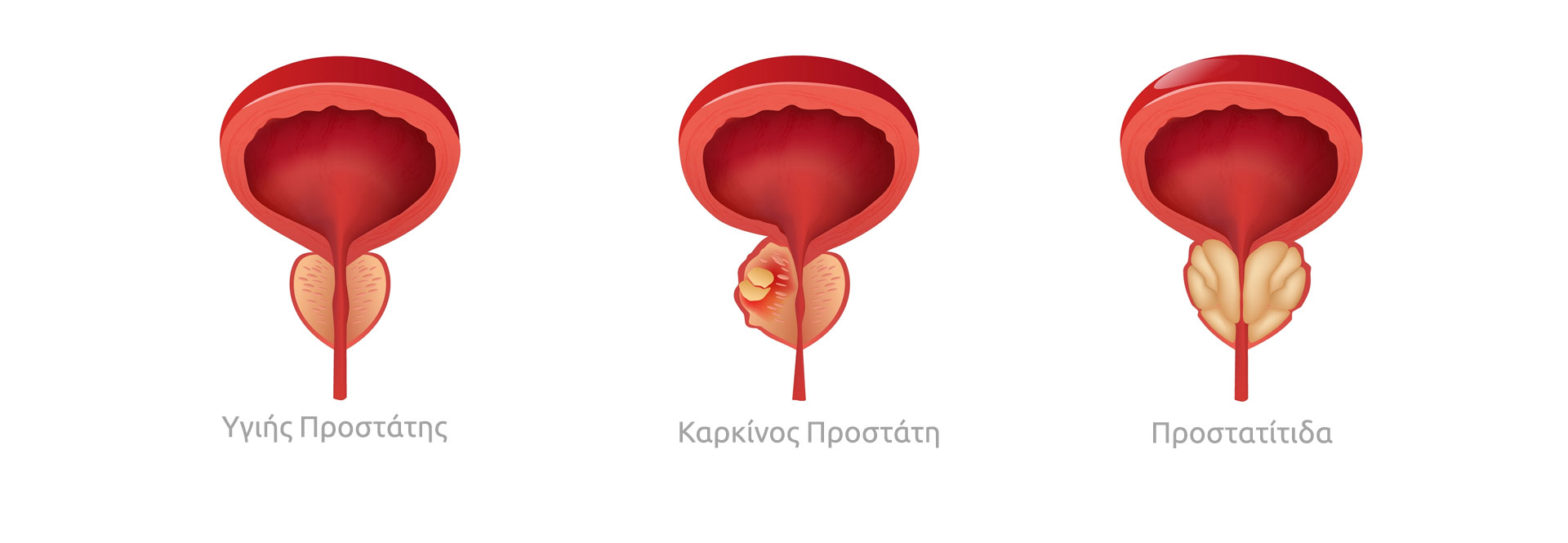 Τι πρέπει να ξέρουμε για την οξεία και χρόνια προστατίτιδα (BINTEO)